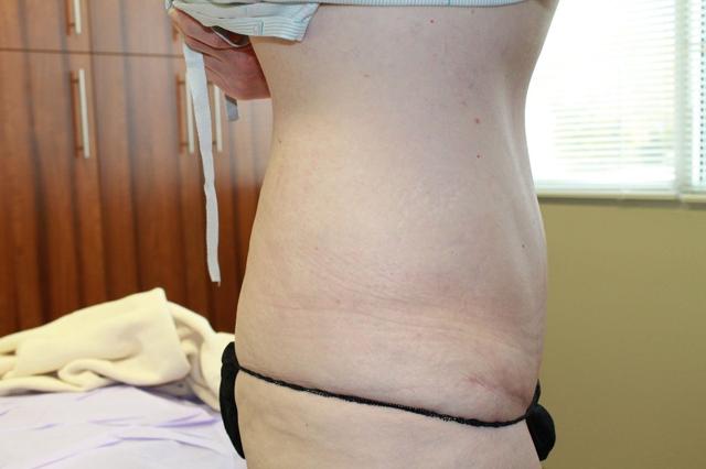 Tummy Tuck after at Boulder Valley Plastic Surgery in Boulder, CO