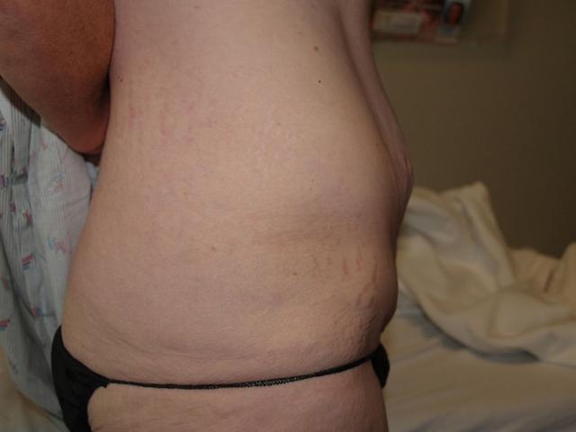 Tummy Tuck before at Boulder Valley Plastic Surgery in Boulder, CO