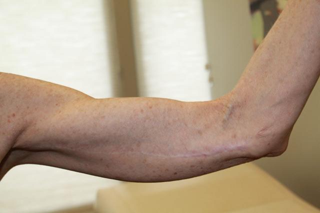Arm Lift after at Boulder Valley Plastic Surgery in Boulder, CO