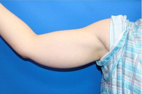 Liposuction before at Boulder Valley Plastic Surgery in Boulder, CO