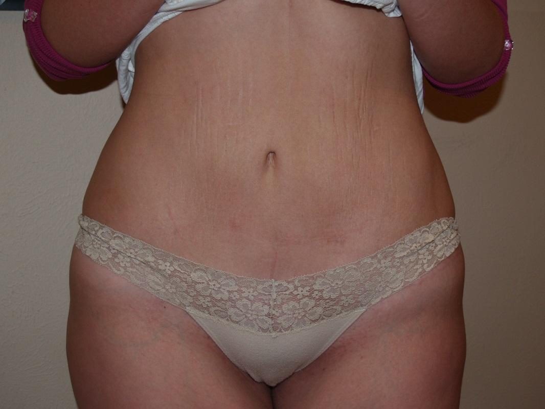 Boulder Valley Plastic Surgery tummy tuck after — Boulder, CO