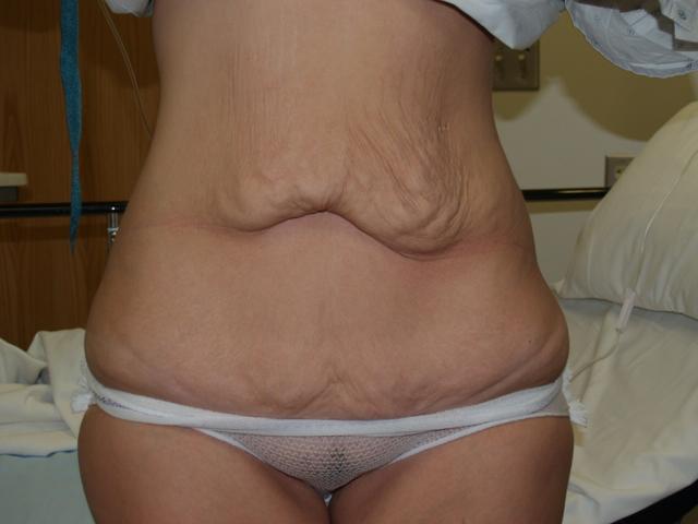 Tummy Tuck before at Boulder Valley Plastic Surgery in Boulder, CO