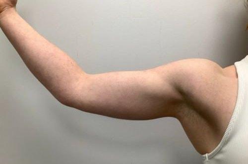 Liposuction after at Boulder Valley Plastic Surgery in Boulder, CO