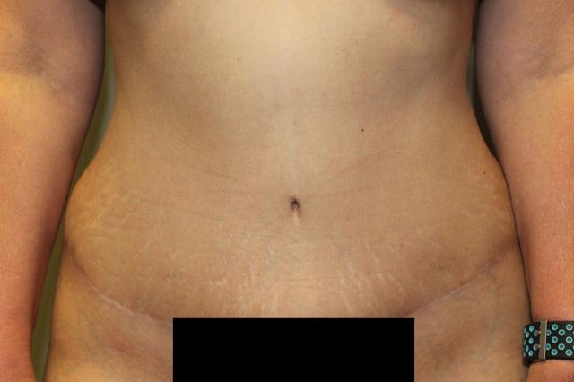Tummy Tuck after at Boulder Valley Plastic Surgery in Boulder, CO