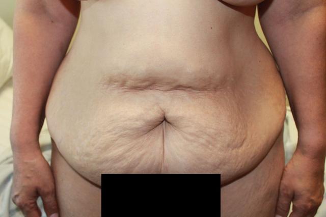 Tummy Tuck before at Boulder Valley Plastic Surgery in Boulder, CO