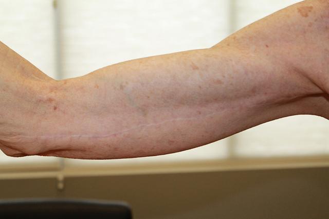 Arm Lift after at Boulder Valley Plastic Surgery in Boulder, CO