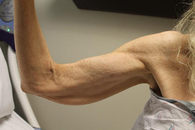 Arm Lift before at Boulder Valley Plastic Surgery in Boulder, CO