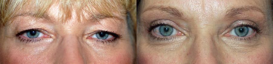 Ioannis P Glavas, MD eyelid lift result — Boston, MA