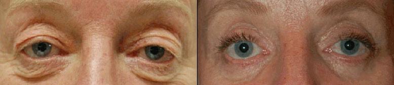 Ioannis P Glavas, MD eyelid lift result — Boston, MA