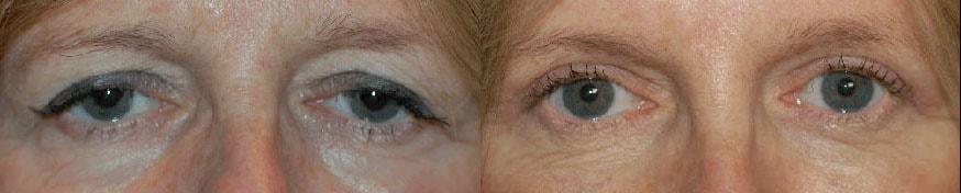 Ioannis P Glavas, MD eyelid lift result — Boston, MA