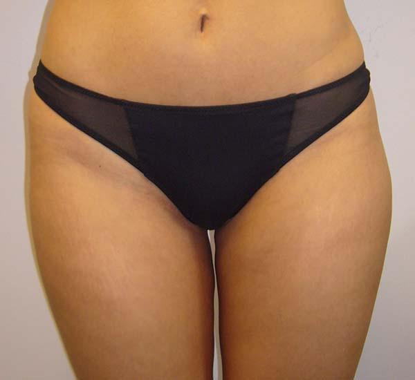Liposuction after at The Pennsylvania Centre for Plastic Surgery: Scott A. Brenman, M.D., F.A.C.S. in Philadelphia, PA