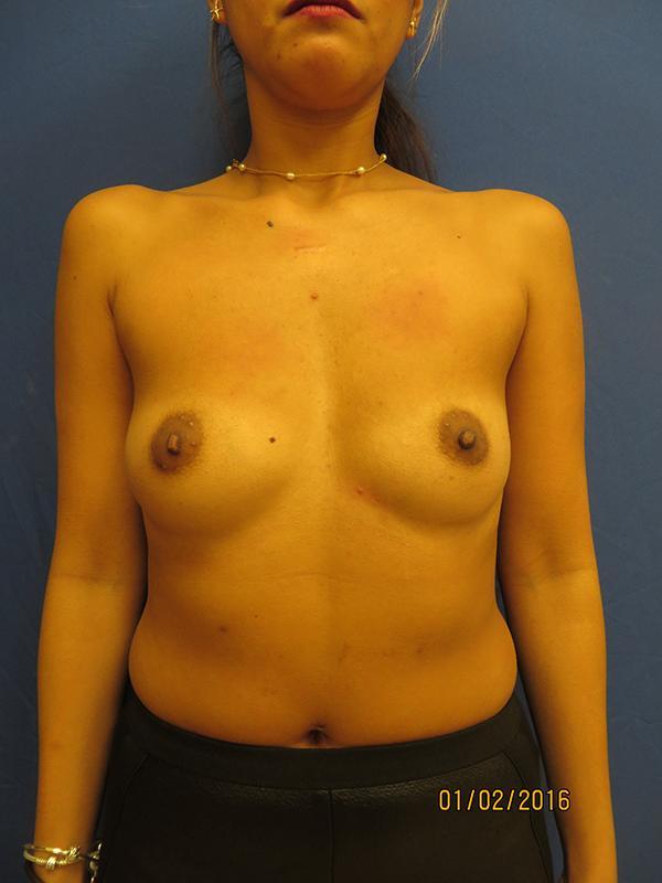 Breast Augmentation before at The Pennsylvania Centre for Plastic Surgery: Scott A. Brenman, M.D., F.A.C.S. in Philadelphia, PA