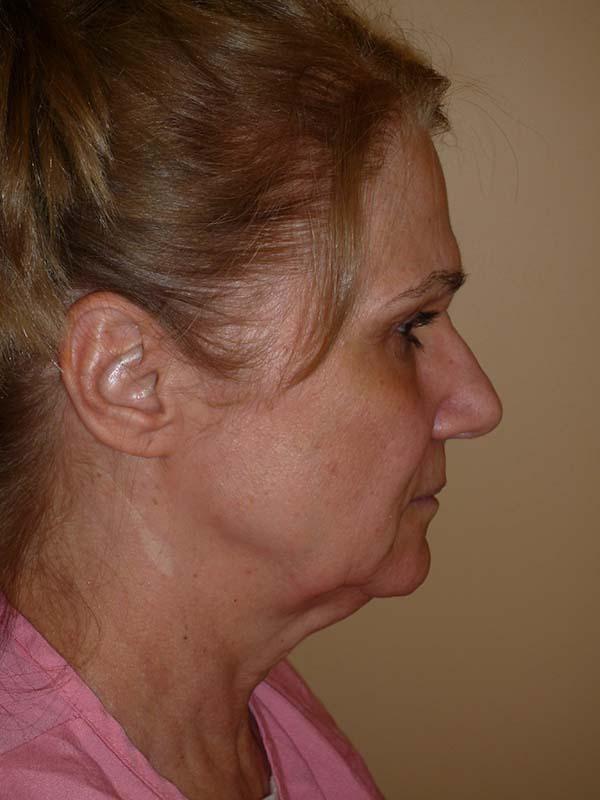 Facelift before at The Pennsylvania Centre for Plastic Surgery: Scott A. Brenman, M.D., F.A.C.S. in Philadelphia, PA