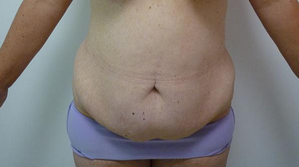 Mini Tummy Tuck before at The Pennsylvania Centre for Plastic Surgery: Scott A. Brenman, M.D., F.A.C.S. in Philadelphia, PA