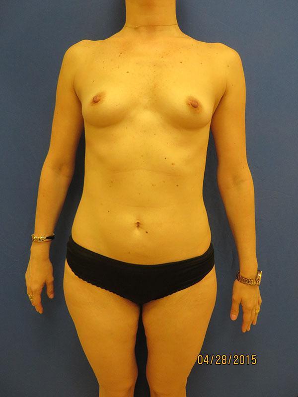 Breast Augmentation before at The Pennsylvania Centre for Plastic Surgery: Scott A. Brenman, M.D., F.A.C.S. in Philadelphia, PA