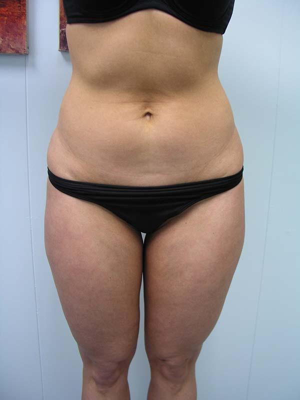 Liposuction before at The Pennsylvania Centre for Plastic Surgery: Scott A. Brenman, M.D., F.A.C.S. in Philadelphia, PA