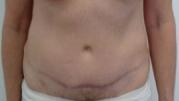 Mini Tummy Tuck after at The Pennsylvania Centre for Plastic Surgery: Scott A. Brenman, M.D., F.A.C.S. in Philadelphia, PA
