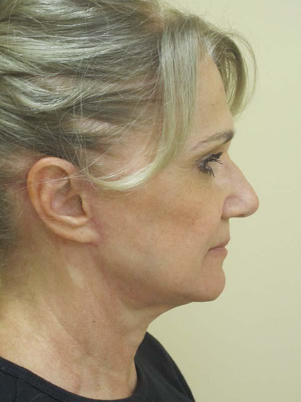 The Pennsylvania Centre for Plastic Surgery: Scott A. Brenman, M.D., F.A.C.S. facelift after — Philadelphia, PA