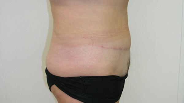 Mini Tummy Tuck after at The Pennsylvania Centre for Plastic Surgery: Scott A. Brenman, M.D., F.A.C.S. in Philadelphia, PA
