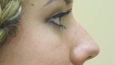 Functional Rhinoplasty before at The Pennsylvania Centre for Plastic Surgery: Scott A. Brenman, M.D., F.A.C.S. in Philadelphia, PA