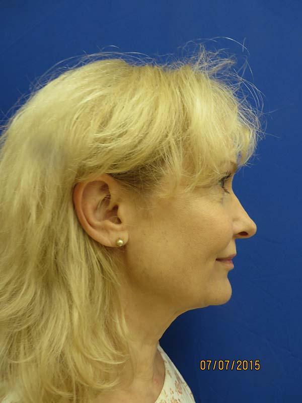 Facelift before at The Pennsylvania Centre for Plastic Surgery: Scott A. Brenman, M.D., F.A.C.S. in Philadelphia, PA