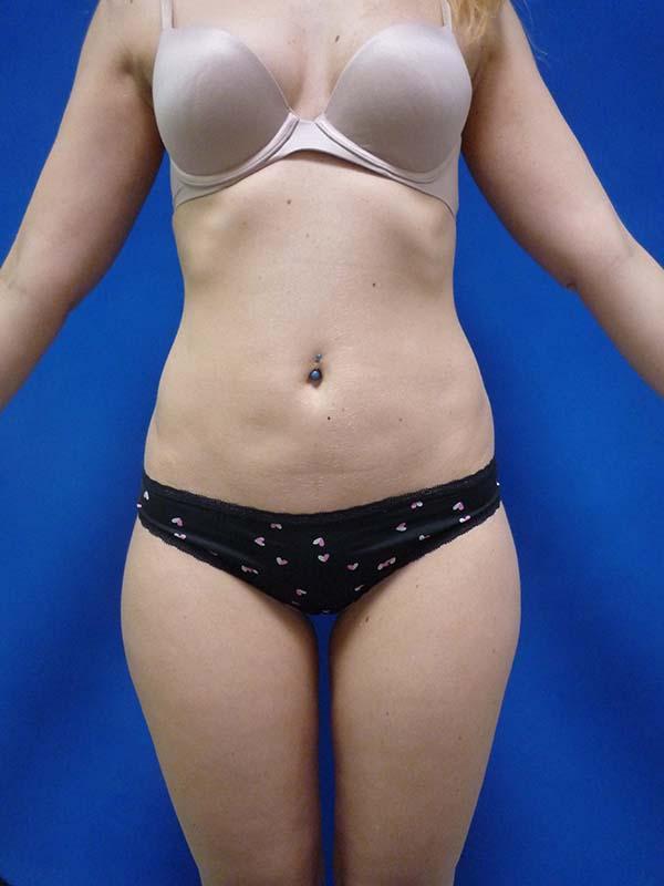 Liposuction after at The Pennsylvania Centre for Plastic Surgery: Scott A. Brenman, M.D., F.A.C.S. in Philadelphia, PA