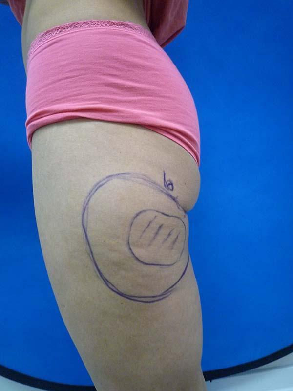 Brazilian Butt Lift before at The Pennsylvania Centre for Plastic Surgery: Scott A. Brenman, M.D., F.A.C.S. in Philadelphia, PA