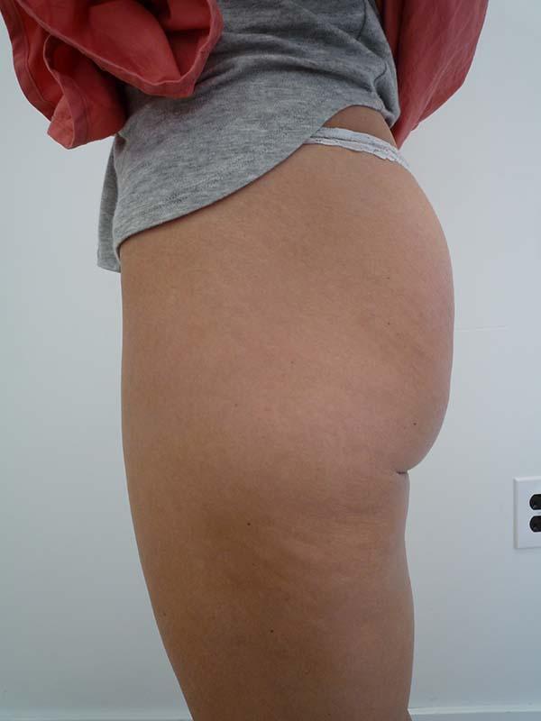 Brazilian Butt Lift after at The Pennsylvania Centre for Plastic Surgery: Scott A. Brenman, M.D., F.A.C.S. in Philadelphia, PA