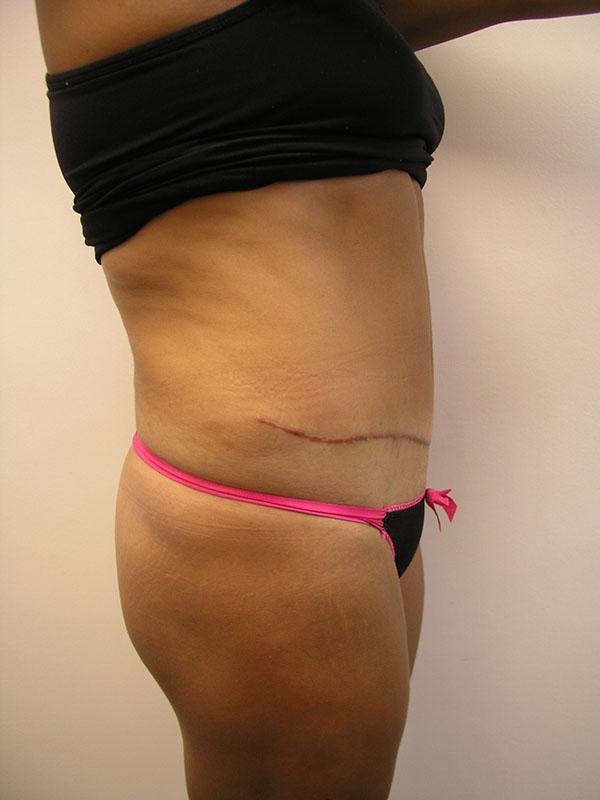 Mini Tummy Tuck after at The Pennsylvania Centre for Plastic Surgery: Scott A. Brenman, M.D., F.A.C.S. in Philadelphia, PA