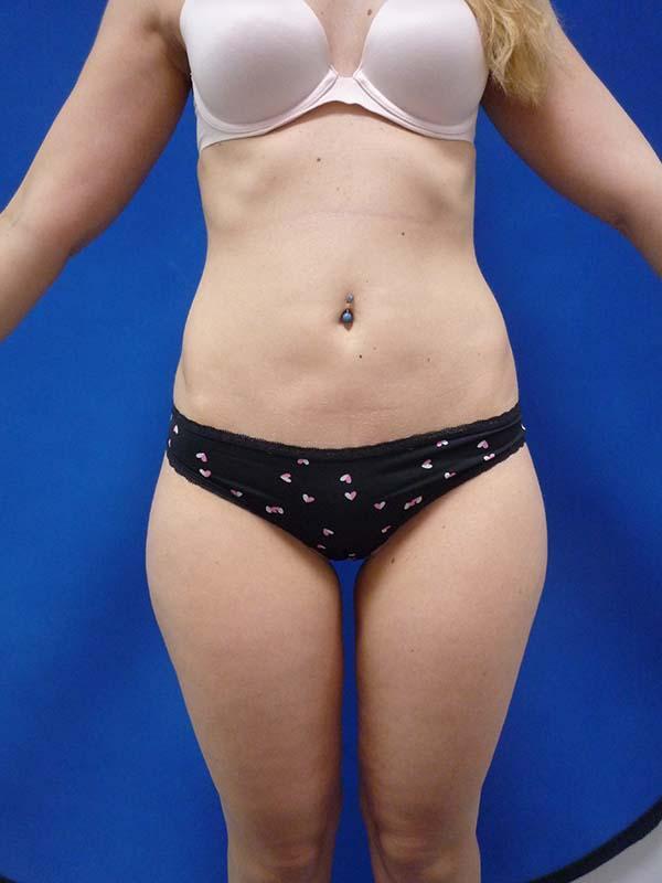 Liposuction before at The Pennsylvania Centre for Plastic Surgery: Scott A. Brenman, M.D., F.A.C.S. in Philadelphia, PA
