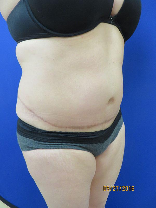 Mini Tummy Tuck after at The Pennsylvania Centre for Plastic Surgery: Scott A. Brenman, M.D., F.A.C.S. in Philadelphia, PA