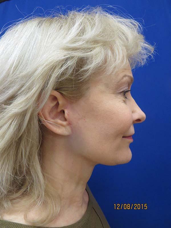 Facelift after at The Pennsylvania Centre for Plastic Surgery: Scott A. Brenman, M.D., F.A.C.S. in Philadelphia, PA