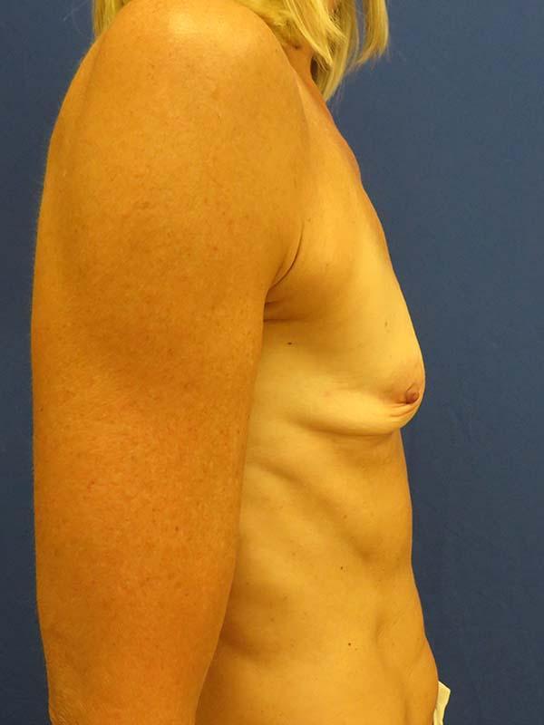 Breast Augmentation before at The Pennsylvania Centre for Plastic Surgery: Scott A. Brenman, M.D., F.A.C.S. in Philadelphia, PA