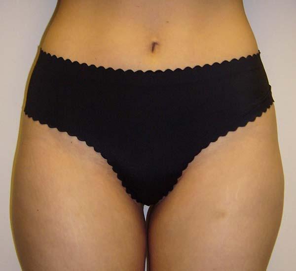 Liposuction before at The Pennsylvania Centre for Plastic Surgery: Scott A. Brenman, M.D., F.A.C.S. in Philadelphia, PA