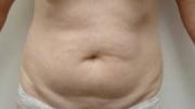Mini Tummy Tuck before at The Pennsylvania Centre for Plastic Surgery: Scott A. Brenman, M.D., F.A.C.S. in Philadelphia, PA