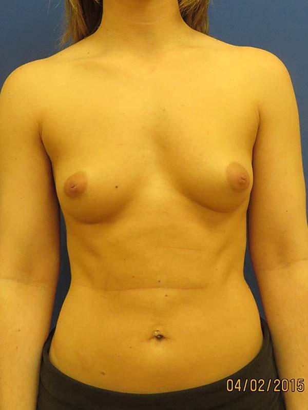Breast Augmentation before at The Pennsylvania Centre for Plastic Surgery: Scott A. Brenman, M.D., F.A.C.S. in Philadelphia, PA