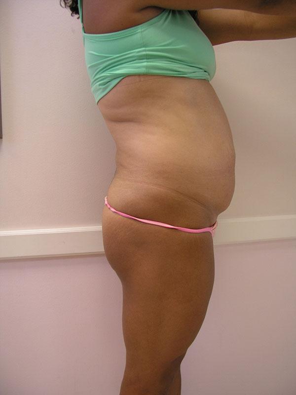 Mini Tummy Tuck before at The Pennsylvania Centre for Plastic Surgery: Scott A. Brenman, M.D., F.A.C.S. in Philadelphia, PA