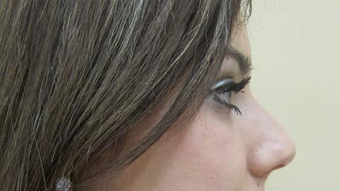 Functional Rhinoplasty after at The Pennsylvania Centre for Plastic Surgery: Scott A. Brenman, M.D., F.A.C.S. in Philadelphia, PA