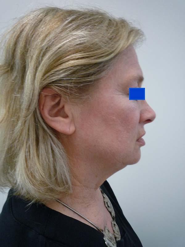 Facelift before at The Pennsylvania Centre for Plastic Surgery: Scott A. Brenman, M.D., F.A.C.S. in Philadelphia, PA