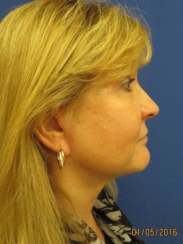 The Pennsylvania Centre for Plastic Surgery: Scott A. Brenman, M.D., F.A.C.S. facelift after — Philadelphia, PA