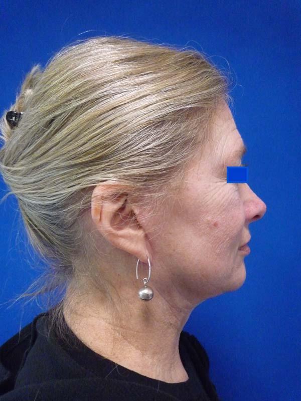 The Pennsylvania Centre for Plastic Surgery: Scott A. Brenman, M.D., F.A.C.S. facelift after — Philadelphia, PA