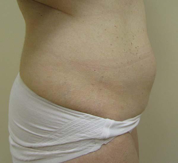 Liposuction before at The Pennsylvania Centre for Plastic Surgery: Scott A. Brenman, M.D., F.A.C.S. in Philadelphia, PA