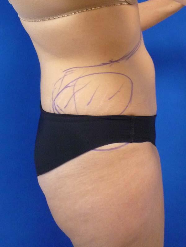 Liposuction before at The Pennsylvania Centre for Plastic Surgery: Scott A. Brenman, M.D., F.A.C.S. in Philadelphia, PA