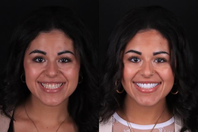 Dental Veneers result at The Practice: Dr. Matt Kasiar, DMD | Franklin, TN in Franklin, TN