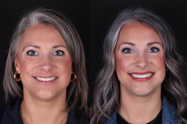 Dental Veneers result at The Practice: Dr. Matt Kasiar, DMD | Franklin, TN in Franklin, TN
