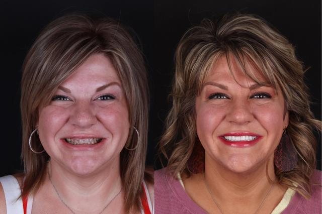 Dental Veneers result at The Practice: Dr. Matt Kasiar, DMD | Franklin, TN in Franklin, TN