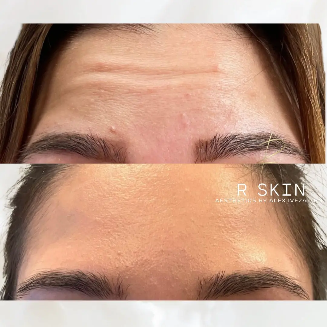 R Skin Aesthetics by Raquel botox result — Birmingham, MI