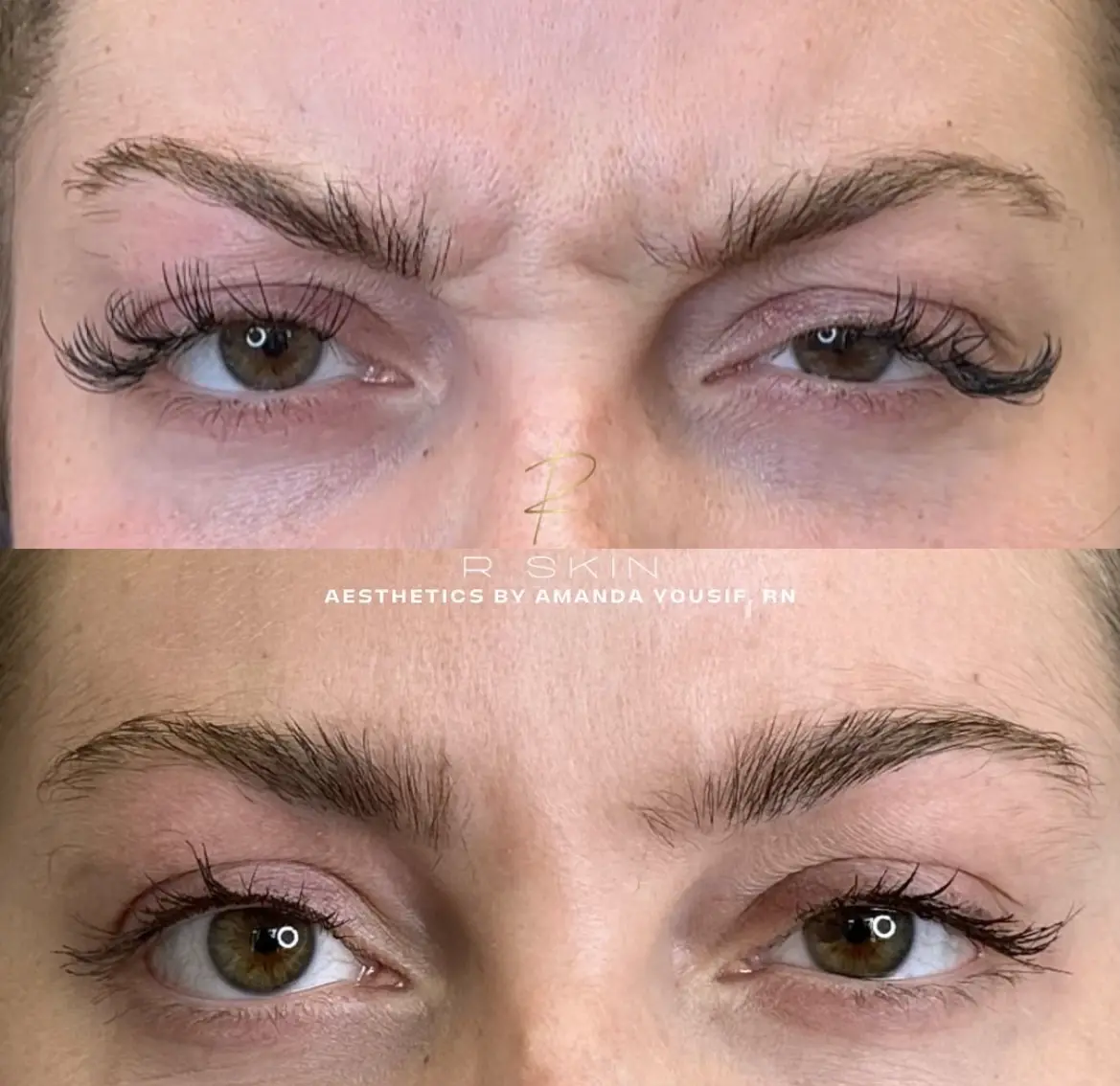 R Skin Aesthetics by Raquel botox result — Birmingham, MI