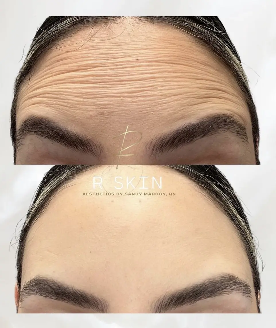 R Skin Aesthetics by Raquel botox result — Birmingham, MI