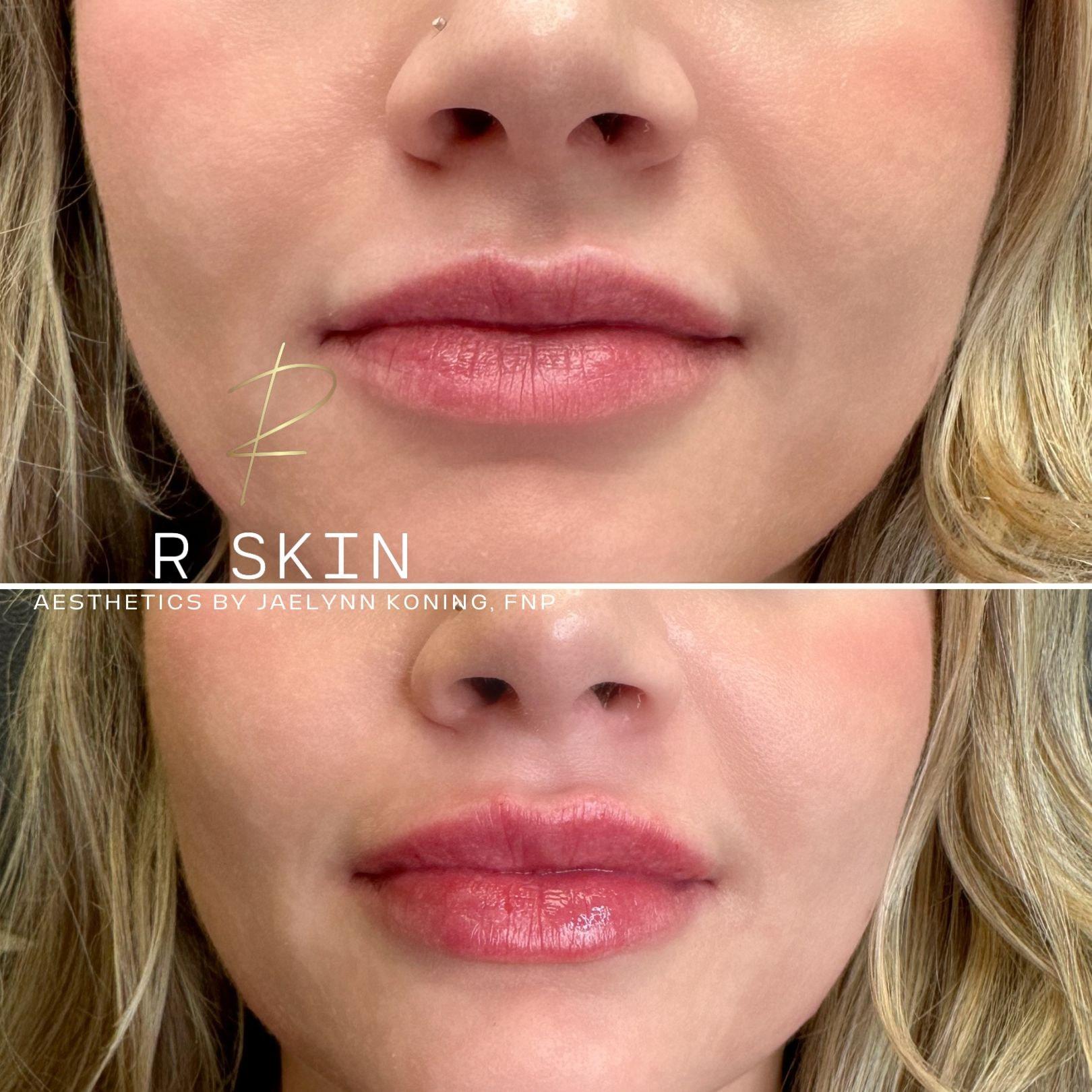 R Skin Aesthetics by Raquel lip filler result — Birmingham, MI